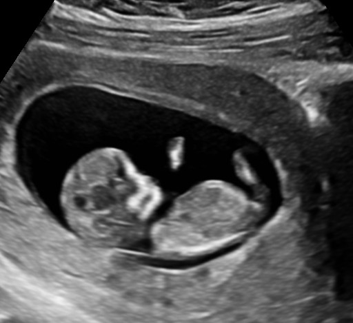 2d private ultrasound 11w baby