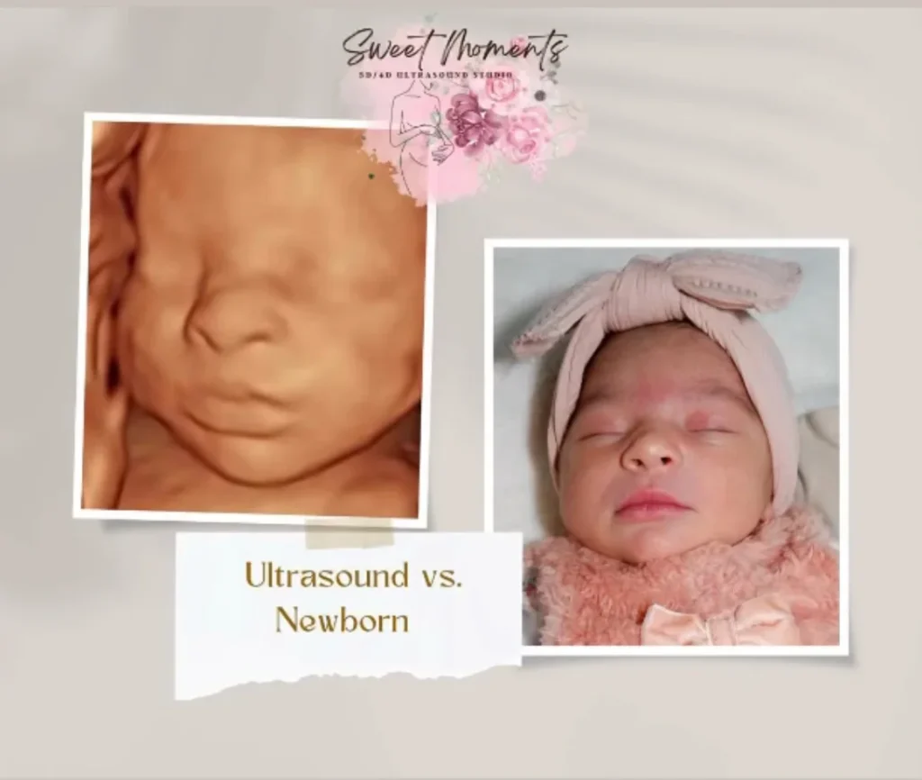 3d ultrasound and newborn comparison