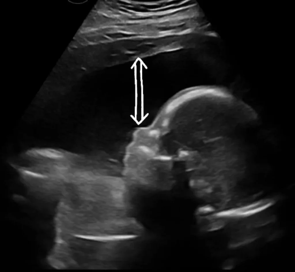 2d ultrasound showing perfect amount of amniotic fluid for 3d ultrasound