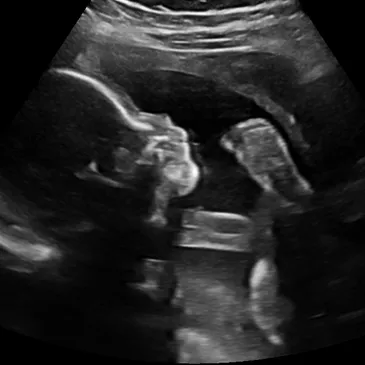 2d ultrasound of baby boy