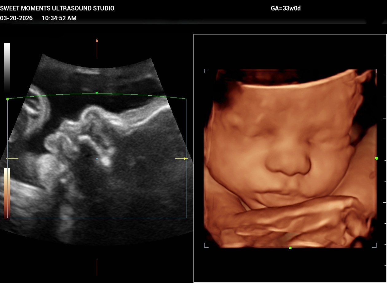 2D 3D ultrasound 33w