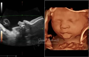 2D 3D ultrasound baby 2
