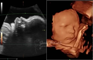 2D 3D ultrasound baby