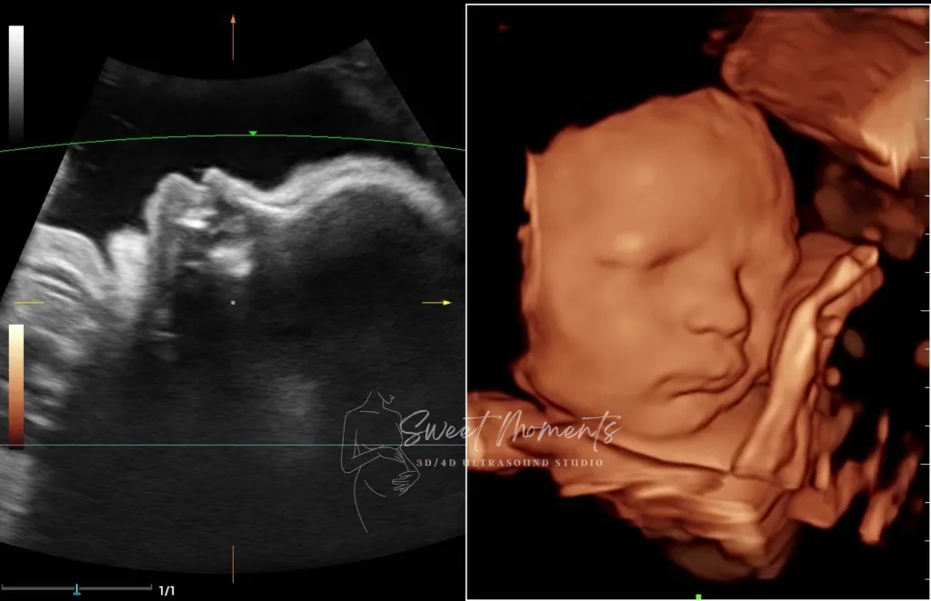 2D 3D ultrasound baby
