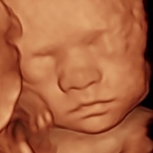 3d ultrasound 27w3d