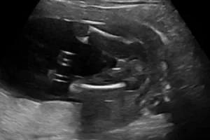 2d ultrasound image of gender