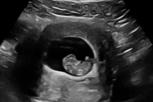 first trimester 2d ultrasound image